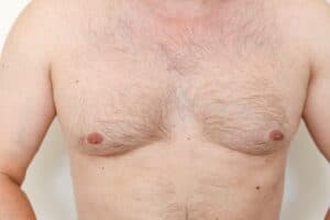 Gynecomastia Candidates Orlando