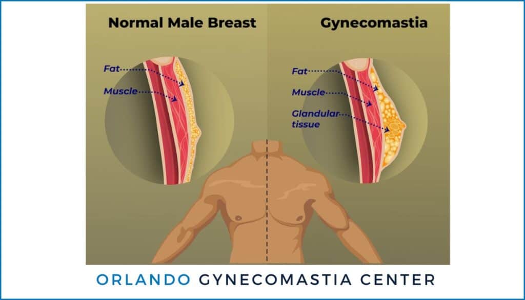 Gynecomastia Orlando FL