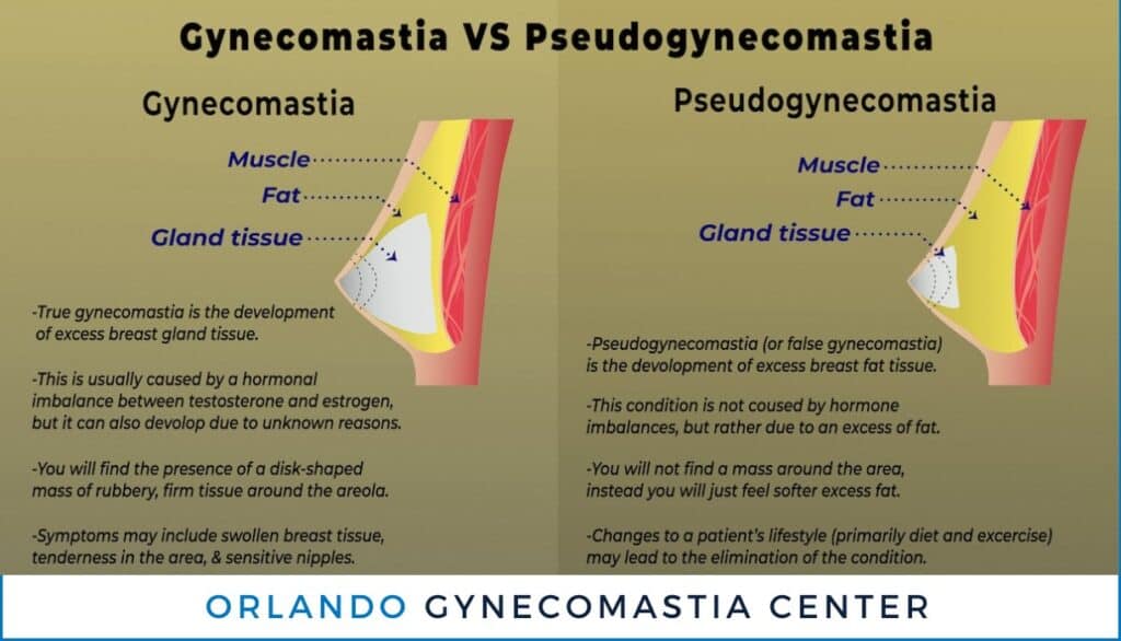 Pseudogynecomastia Surgery Orlando FL