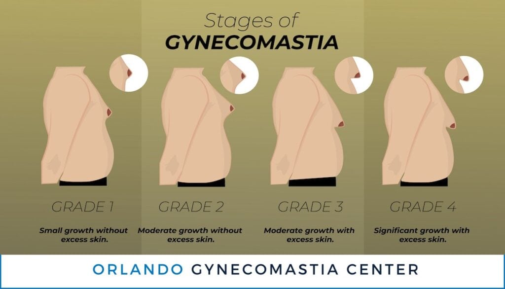 The Stages Grades of Gynecomastia
